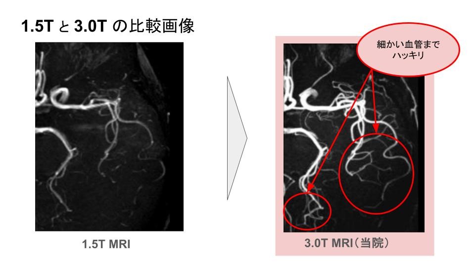 【画像】1.Tと3.0Tの比較画像 細かい血管までハッキリ