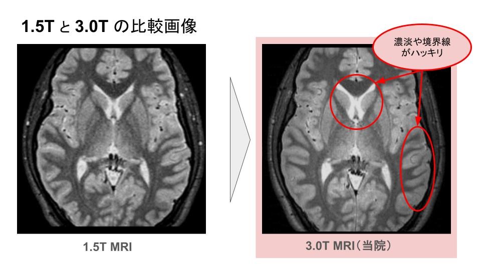 【画像】1.Tと3.0Tの比較画像 濃淡や境界線がハッキリ